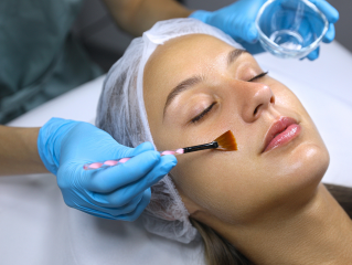 Chemical Peels