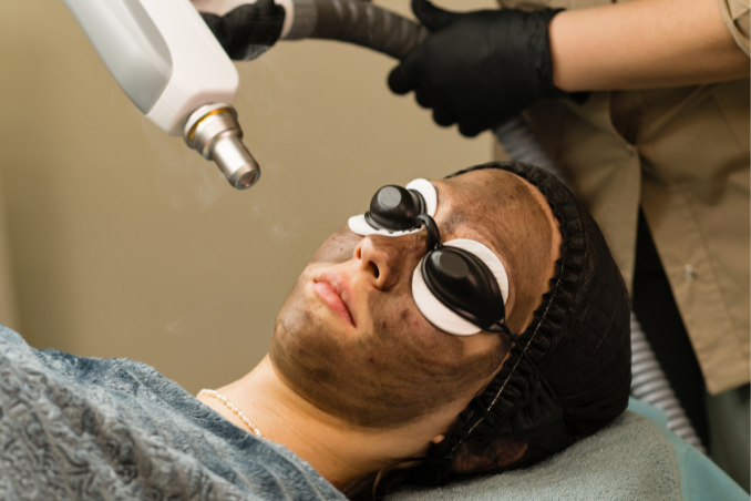 Carbon Laser Peel Treatment