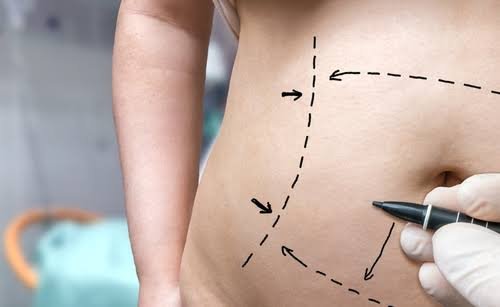 Body Toning and Tucks Treatment