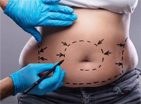 Body Toning and Tucks Treatment Process