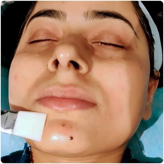 Chemical peel treatment consultation at Cosme Wellness
