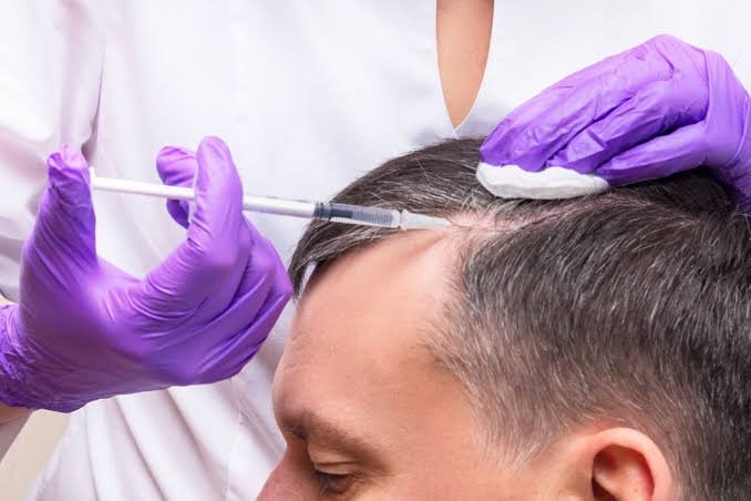 Hair PRP Therapy at Cosme Wellness