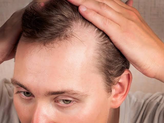 Androgenic Alopecia Treatment