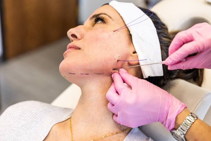 Thread Lift Treatment