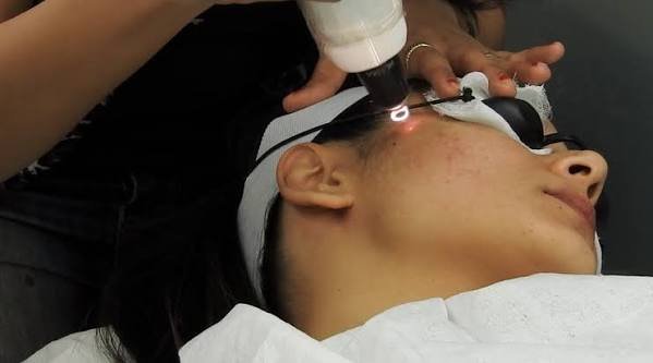 Q-Switch Treatment Laser Process