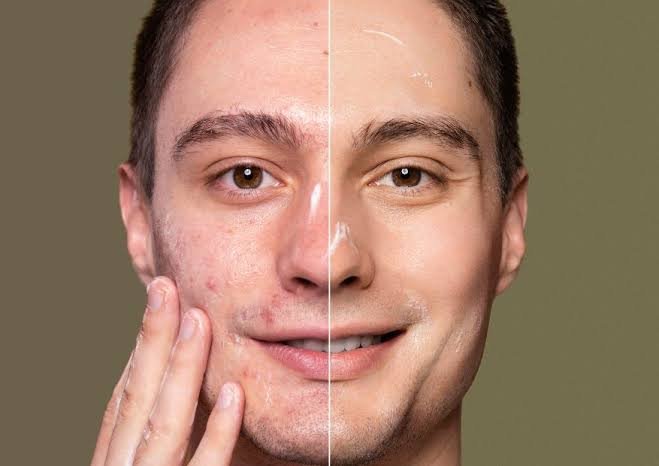 Pico Laser Treatment