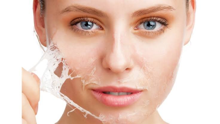 TCA Peel Treatment